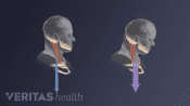 Comparison of neutral head posture and forward head tilt