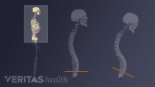 Profile views showing incorrect and correct spinal posture