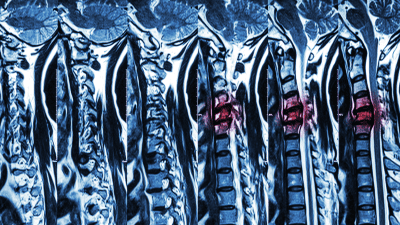 MRI Scan of spine