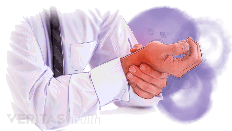 An illustration of a man with wrist pain.