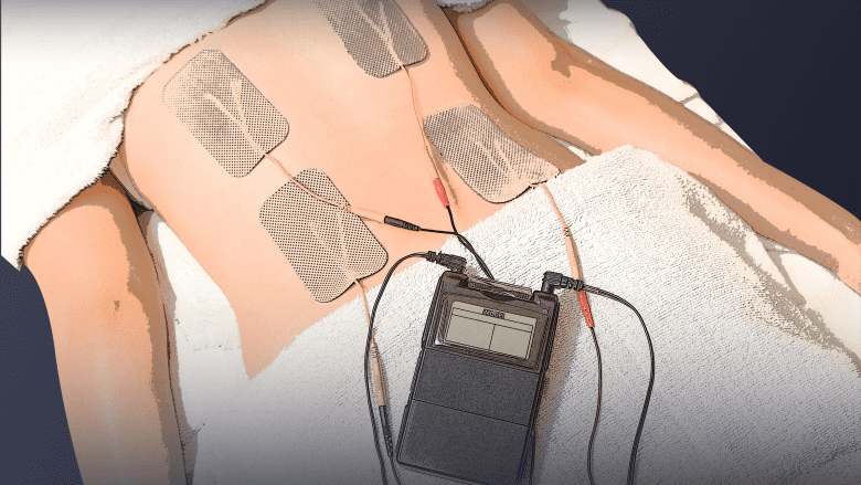 An image showing TENs device electrodes on back muscle.