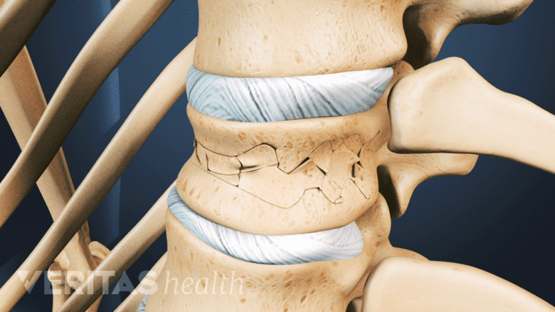 Illustration showing vertebra with fracture.