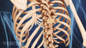 Posterior view of compression fracture bandage location in the vertebra.