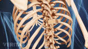 Posterior view of compression fracture bandage location in the vertebra.