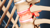 Medical illustration of a vertebral compression fracture