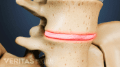 Spondylolisthesis in a disc of the lumbar spine.