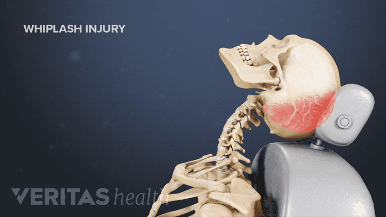 Illustration showing a skeleton with whiplash injury.