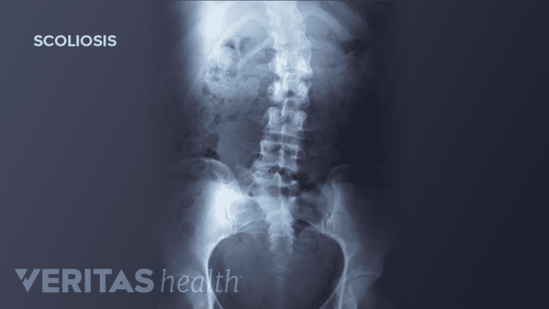 X-ray of spine with scoliosis.