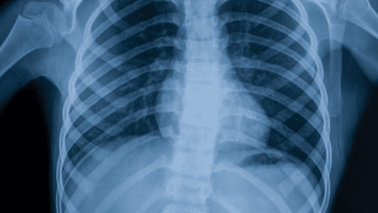 X-ray of torso and spine.